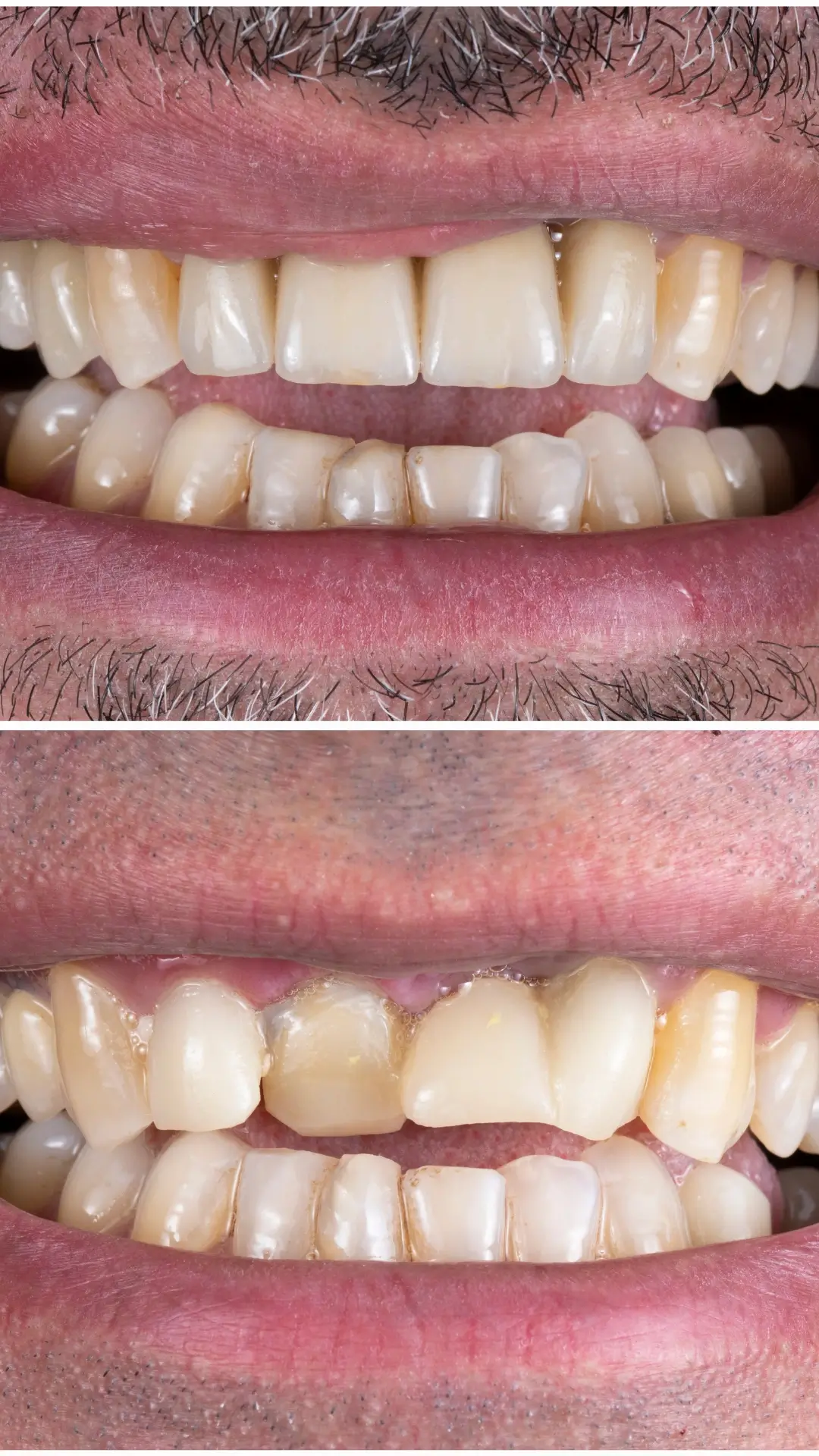 Enamel Bonding & Alignment Correction - Before and After clinical results at Specialist Dental Clinic Guntur