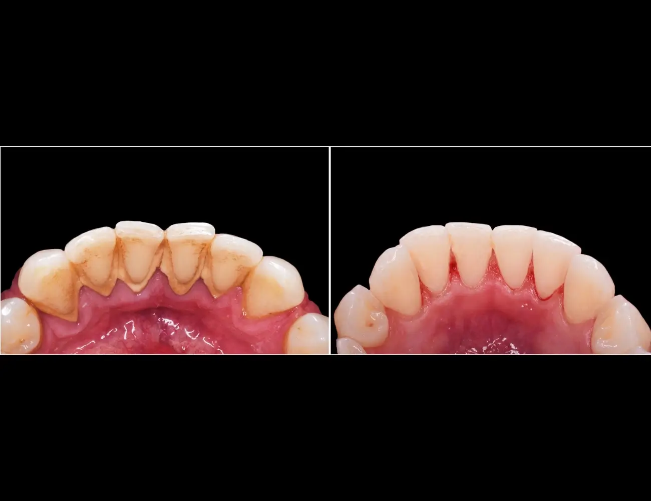 Lingual Tartar & Tobacco Stain Removal - Before and After clinical results at Specialist Dental Clinic Guntur