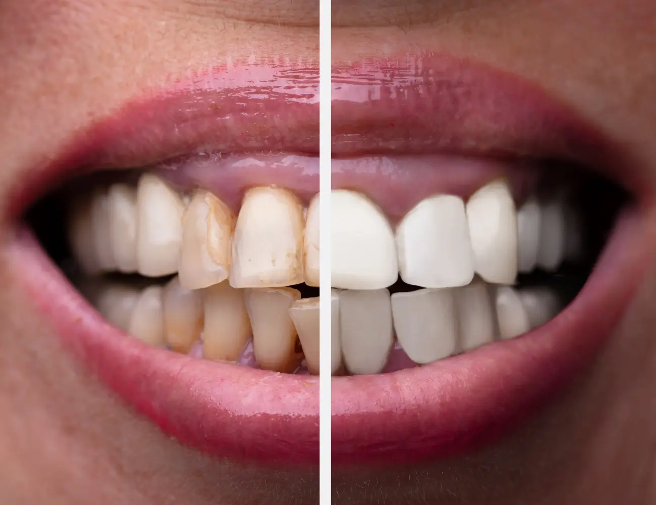 Chairside Dental Whitening & Shade Lift - Before and After clinical results at Specialist Dental Clinic Guntur
