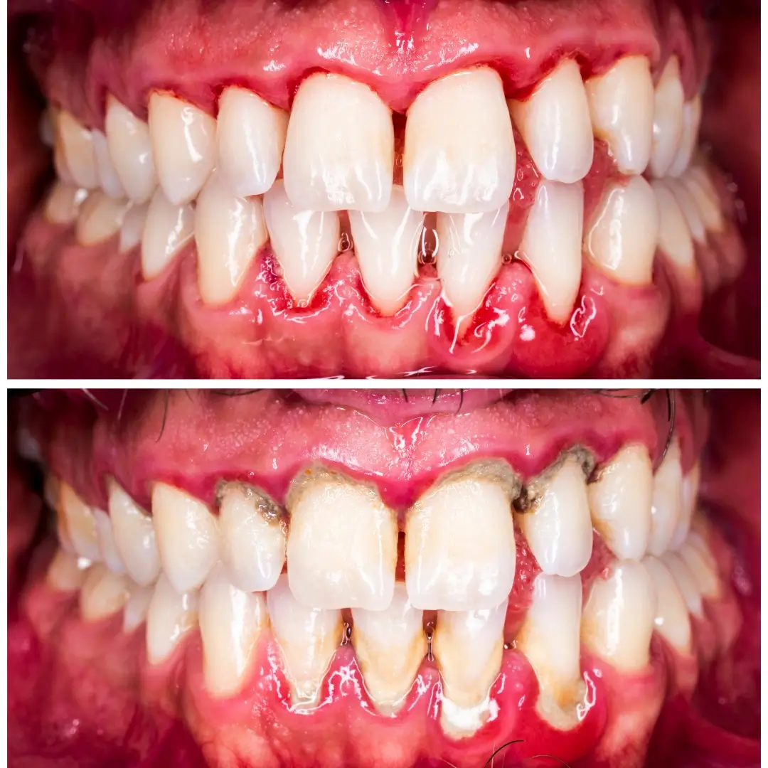 Deep Ultrasonic Scaling & Periodontal Therapy - Before and After clinical results at Specialist Dental Clinic Guntur